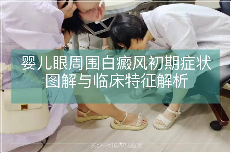 婴儿眼周围白癜风初期症状图解与临床特征解析
