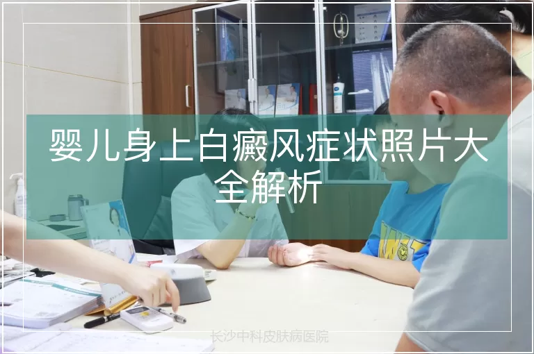 婴儿身上白癜风症状照片大全解析