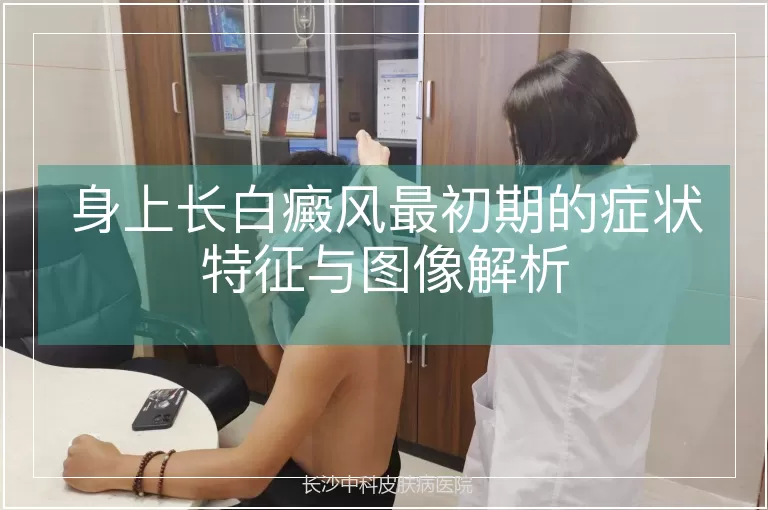 身上长白癜风最初期的症状特征与图像解析