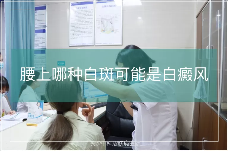腰上哪种白斑可能是白癜风