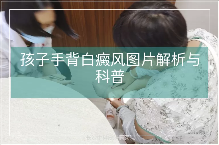 孩子手背白癜风图片解析与科普