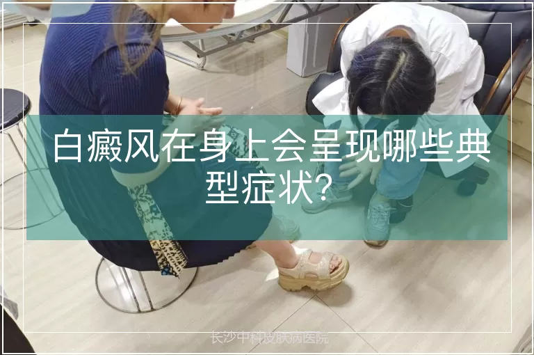 白癜风在身上会呈现哪些典型症状？