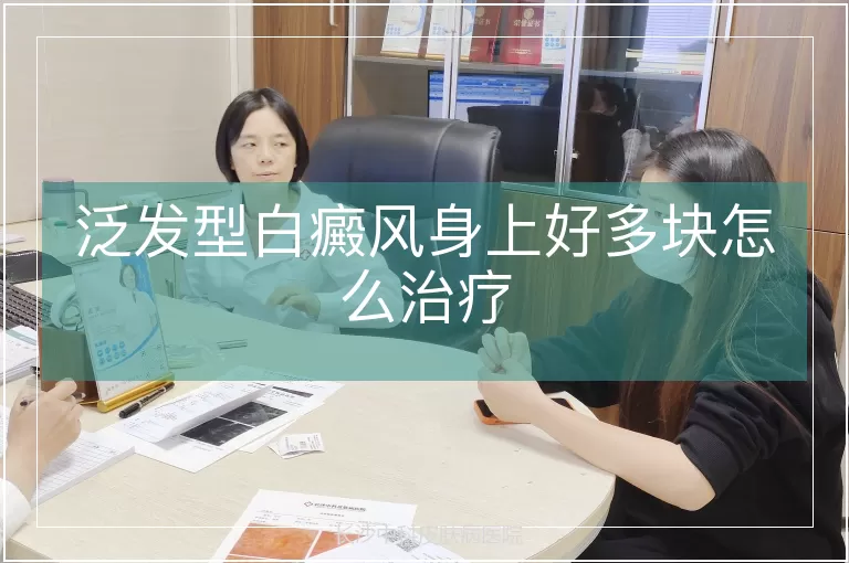 泛发型白癜风身上好多块怎么治疗