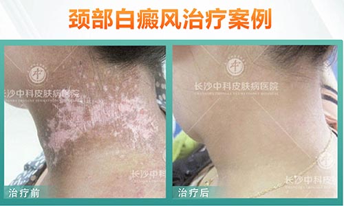 女，17岁 面部白癜风1年